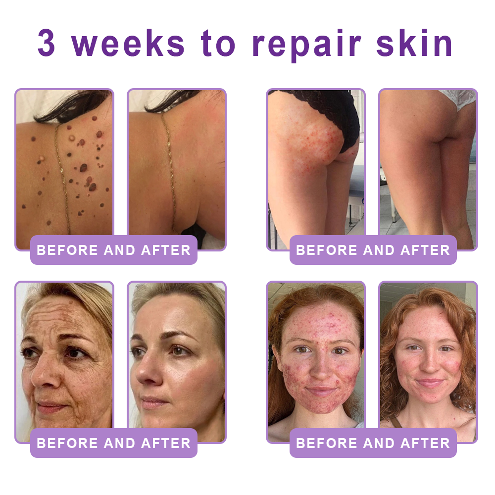 Vitalisys®🎉 PDRN Multi-Peptide Massaging Body Roller Cream- Anti-aging, Hydrating, Skin Firming & Lifting, Skin Repair, Even Tone, Acne and Dark Spot Treatment, Wart and Mole Removal, and Psoriasis Relief.