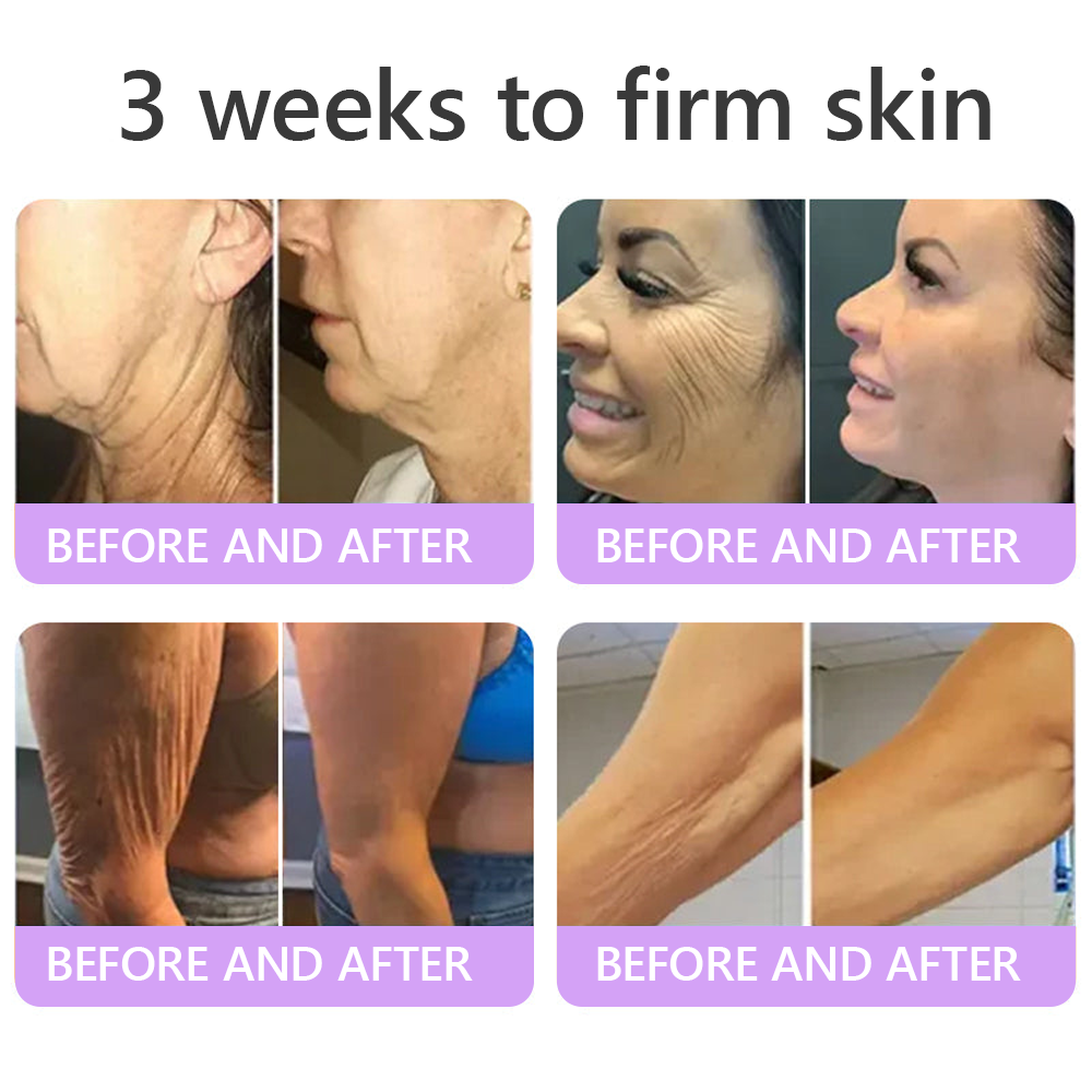 Vitalisys®🎉 PDRN Multi-Peptide Massaging Body Roller Cream- Anti-aging, Hydrating, Skin Firming & Lifting, Skin Repair, Even Tone, Acne and Dark Spot Treatment, Wart and Mole Removal, and Psoriasis Relief.