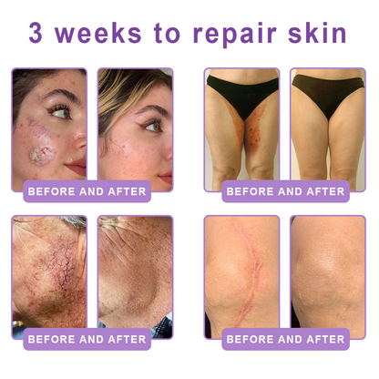 Vitalisys®🎉 PDRN Multi-Peptide Massaging Body Roller Cream- Anti-aging, Hydrating, Skin Firming & Lifting, Skin Repair, Even Tone, Acne and Dark Spot Treatment, Wart and Mole Removal, and Psoriasis Relief.